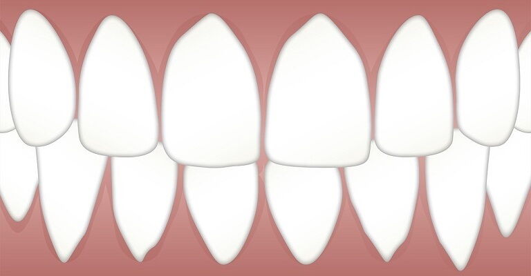 Eine Interimsprothese ersetzt fehlende Zähne temporär.