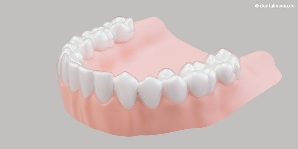 Wie Invisalign-Schienen auf den Zähnen aussehen, ist hier grafisch dargestellt.