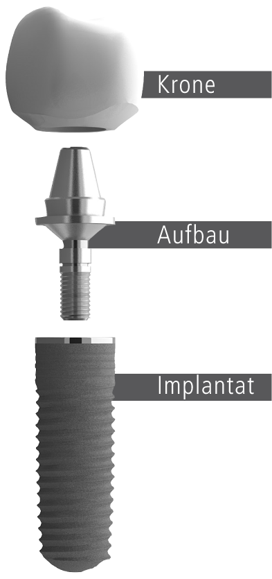 Implantataufbau, grafisch illustriert