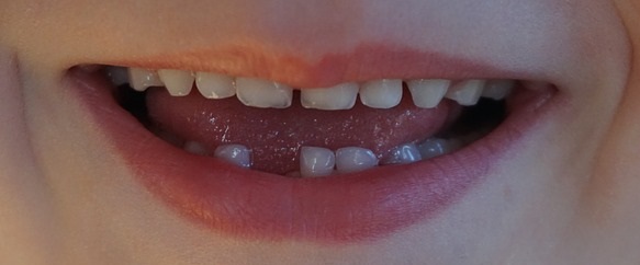 Zahnlücken sind oftmals natürliche Zahnfehlstellungen.