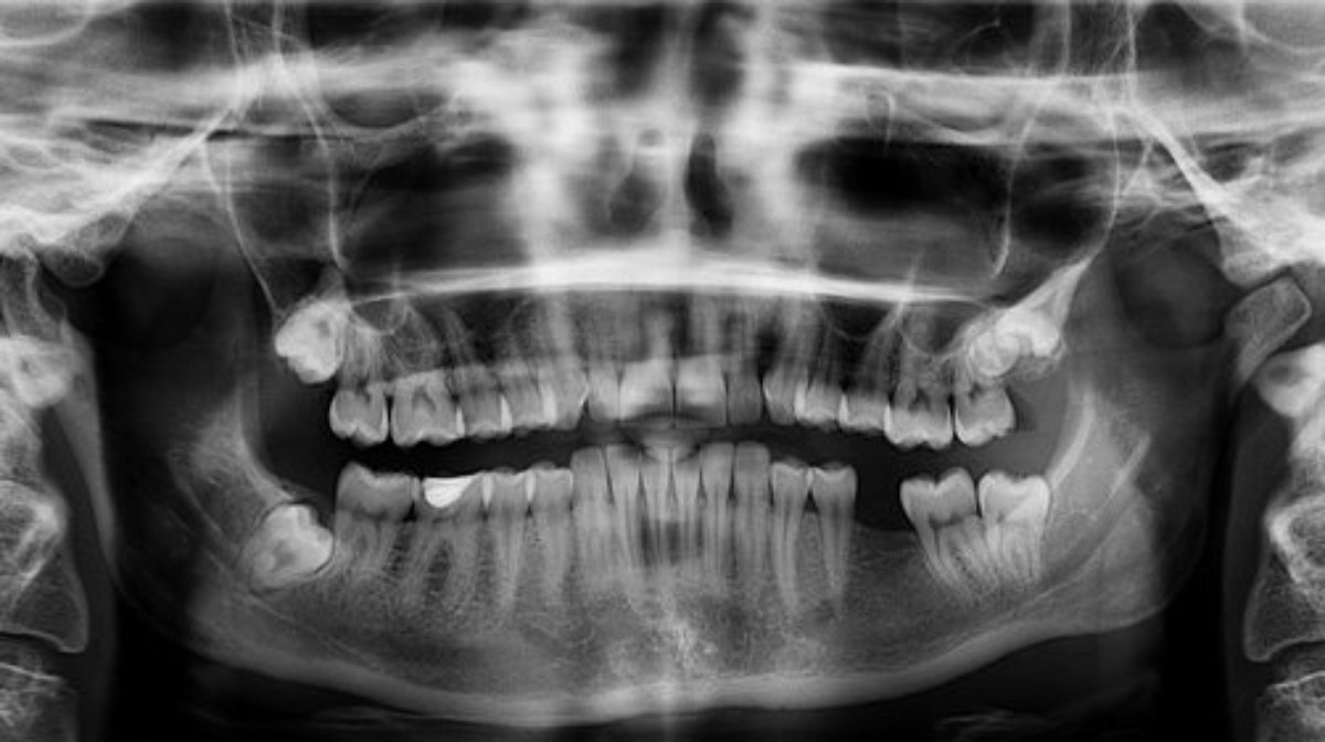 Nichtanlage von Zähnen auf einem Röntgenbild